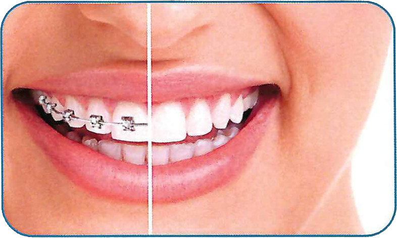 braces & invisalign promotion